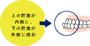 上の前歯が内側に、下の前歯が外側に傾斜