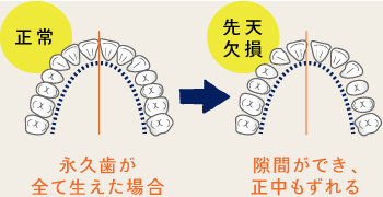 上の前歯が内側に、下の前歯が外側に傾斜