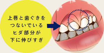 上唇と歯ぐきをつないでいるヒダ部分が下に伸びすぎ