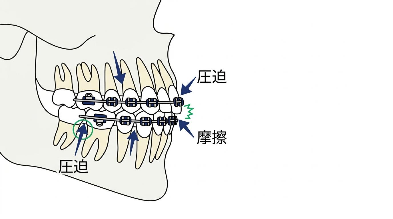 矯正中に痛みが生じる主な原因の図解